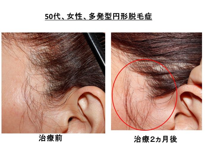 円形脱毛症　病院